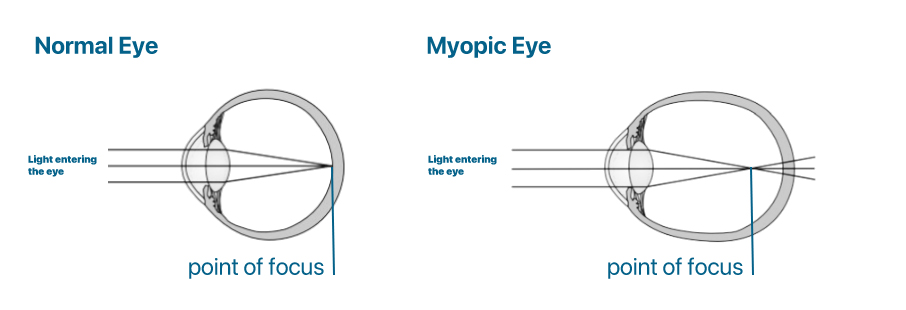 explaining Myopia